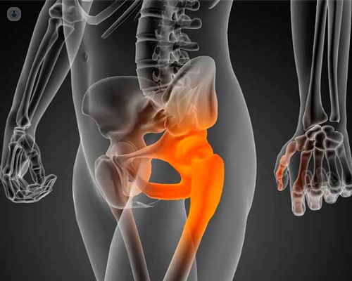 Artrosi all’anca: è la chirurgia l’unica soluzione?