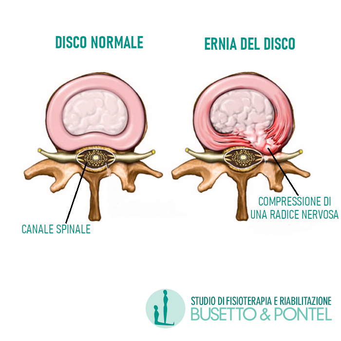 Ernia del disco: una situazione dolorosa che può trovare una soluzione